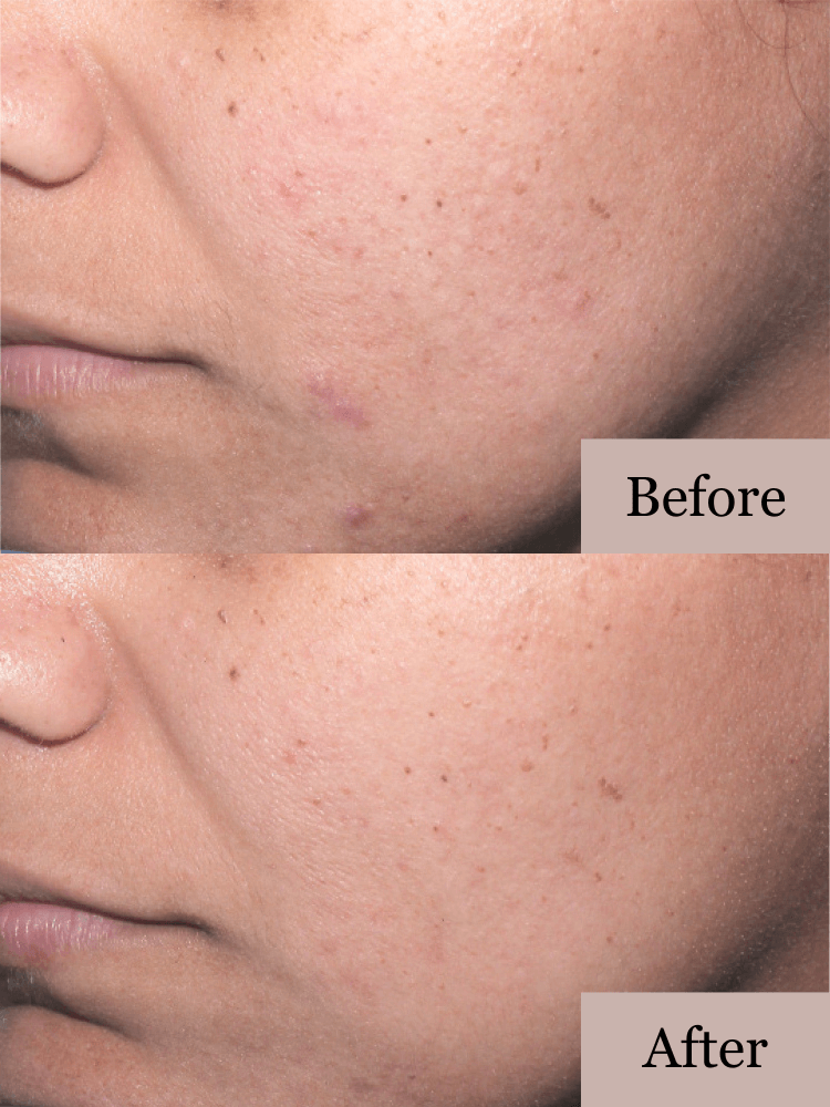 Acne Control System - Before and After