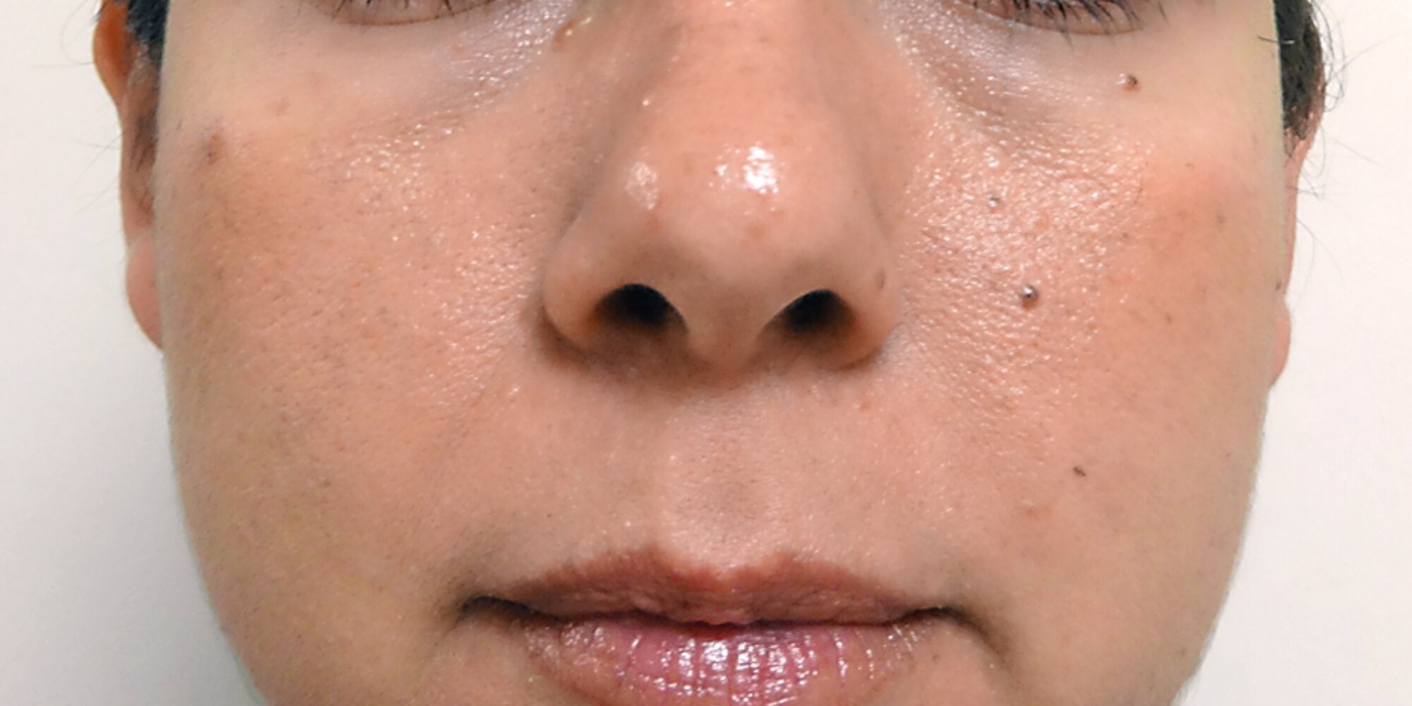 Up close of a woman's face 'after' photo from skincare treatment.
