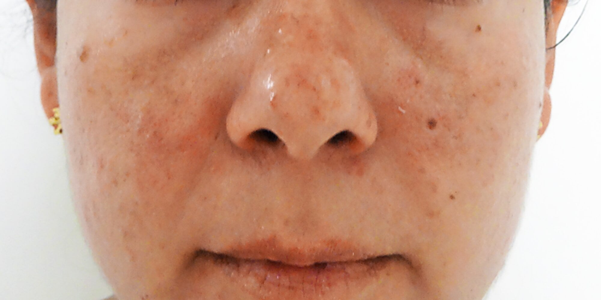 An up close 'before' photo of a woman's face with heavy blemishes.