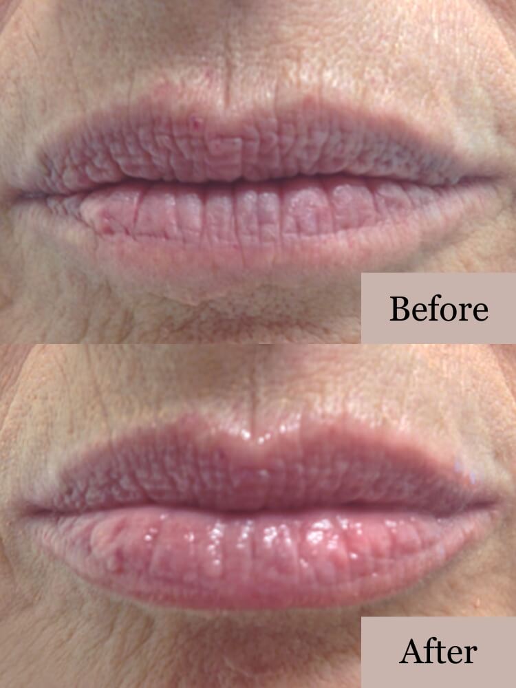 A 'before and after' photo example of a woman's lips, showcasing more plump and hydrated lips.