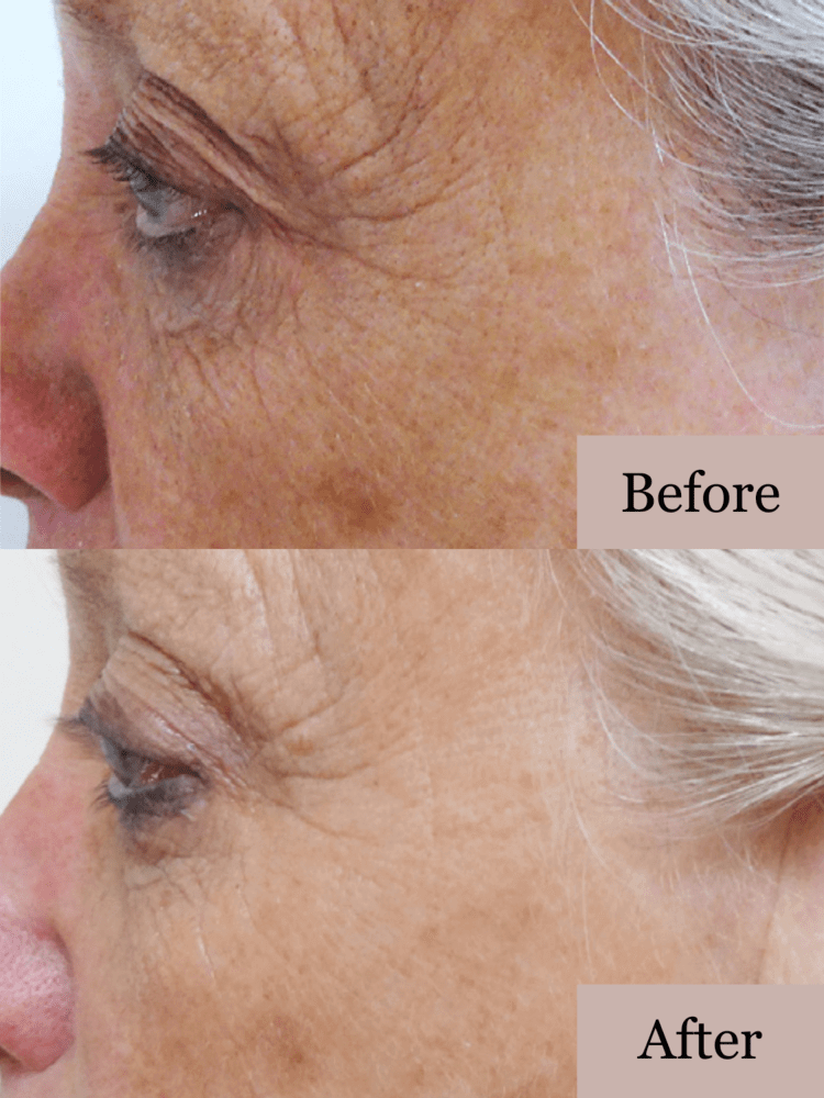 A two picture, 'before and after', example of the side view of a woman's face showcasing less wrinkles.